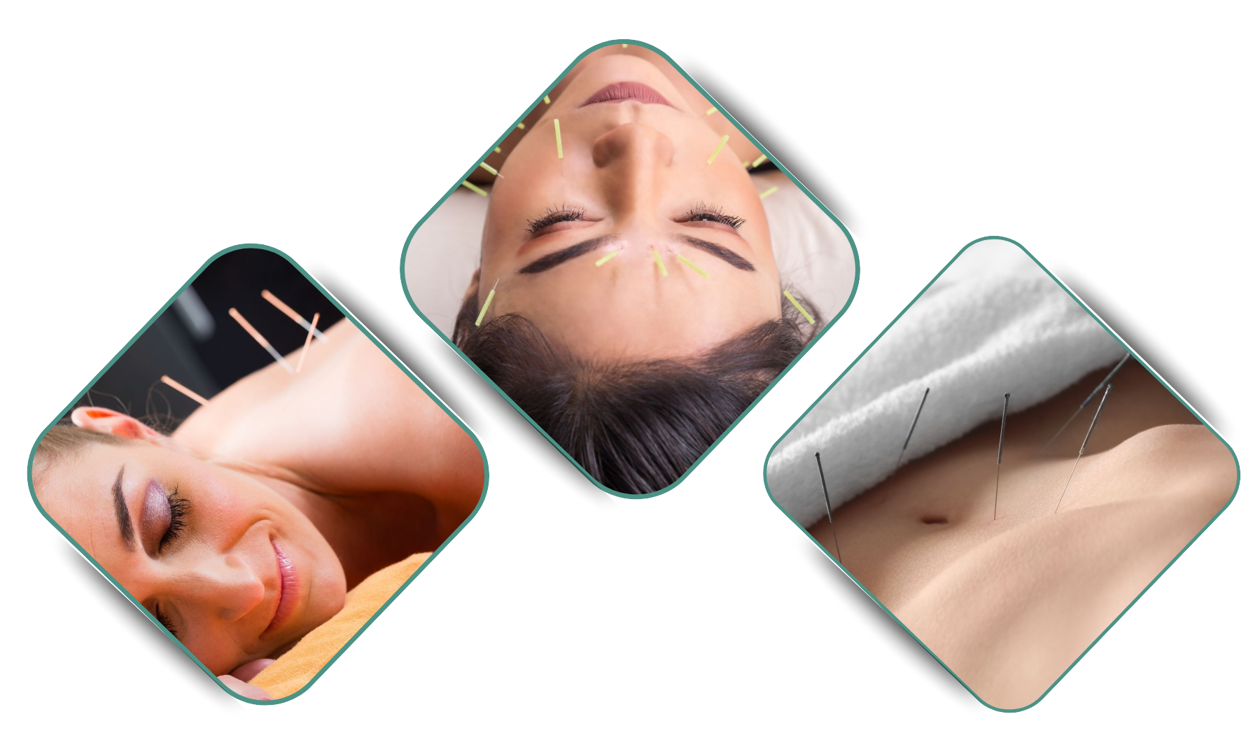 Acupuncture by heal all