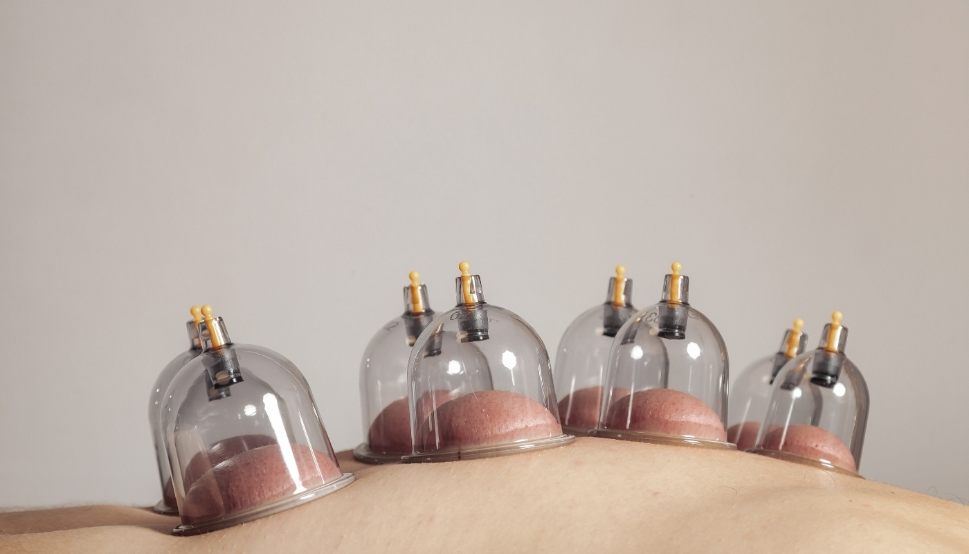 Assessment & Treatment for Cupping Therapy