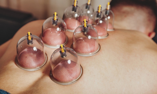 Cupping Massage Therapy Cupping Massage Therapy