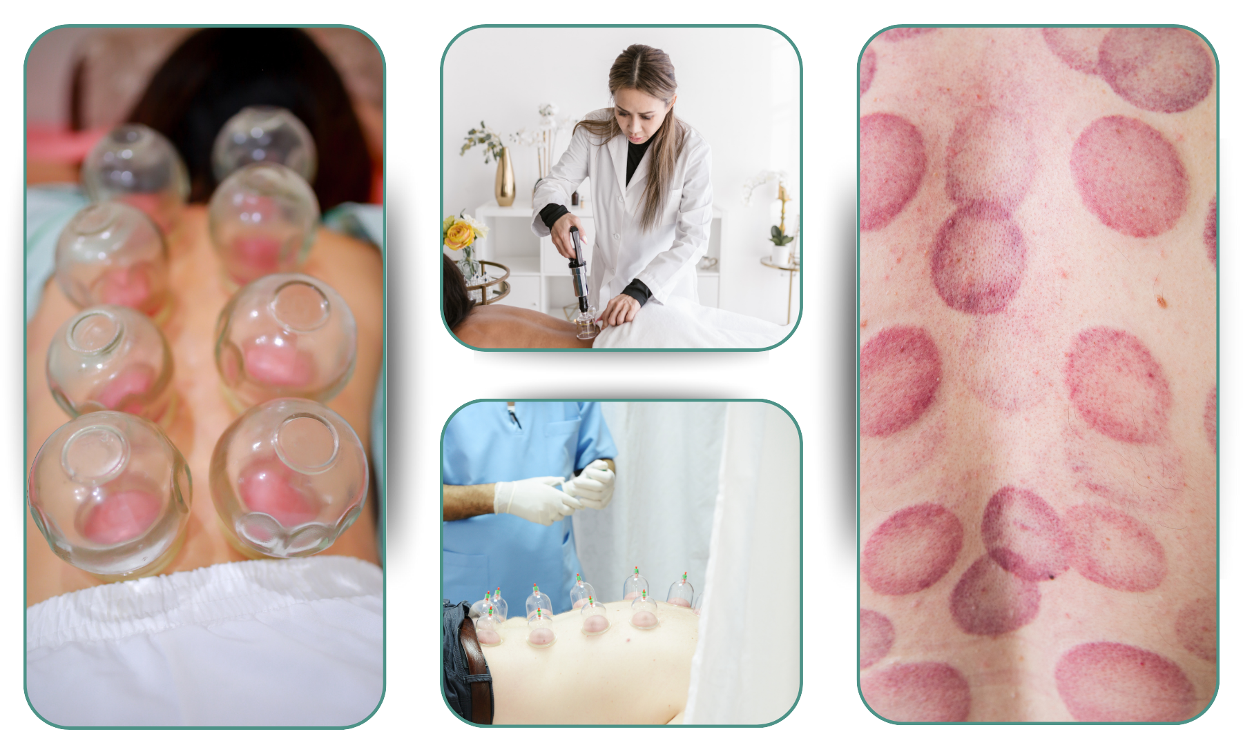 Why Cupping Therapy Works